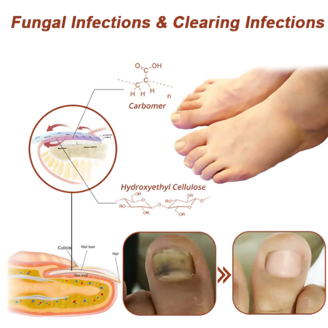 CuraToe™ – Light Therapy for Toenails