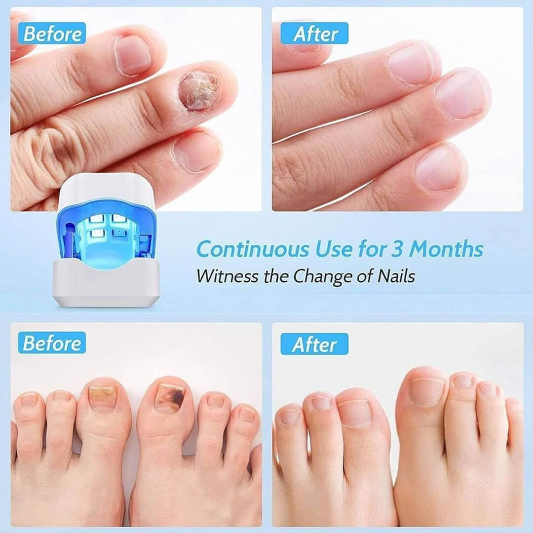 CuraToe™ – Light Therapy for Toenails